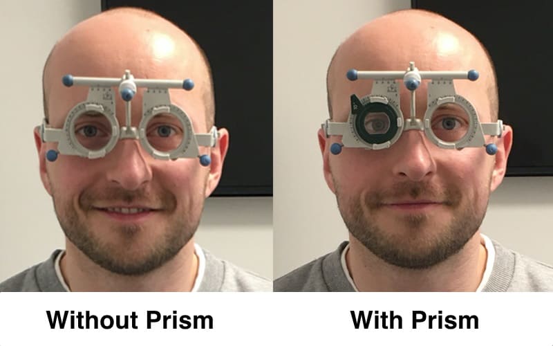 On the right, a lens with a darker frame was placed in front of my eye and the eye behind it positioned itself more inward. This can happenn with your progressive glasses with prism.