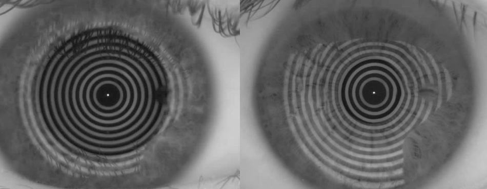 showing a cornea with a good tearful on the left. This way the wearer will get perfect progressive glasses. On the right the shape of the reflected rings is deviated from the optimum. In this case the wearer will not end up with the perfect progressive glasses