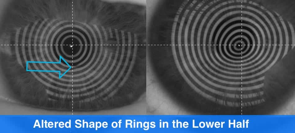 the picture shows when it makes sense to correct keratoconus with progressive lenses and when not to