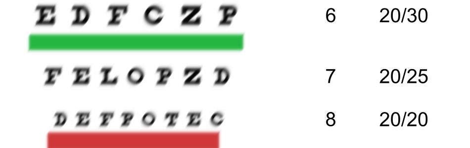 the picture shows the visual experience you will probably have with multifocal intraocular lenses with cataract surgery