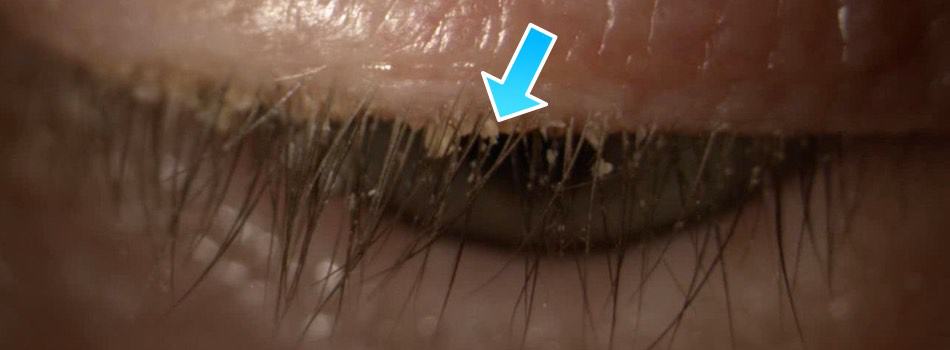 The picture shows flaky deposits in eyelashes