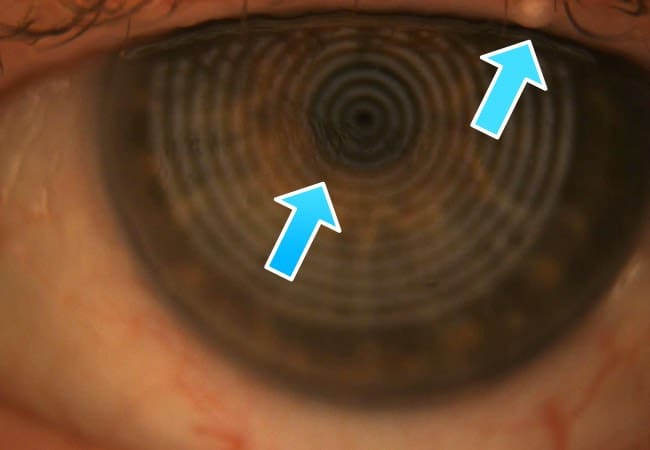 The picture shows a clogged up meibomian gland and a unstable tearfilm which results in a teary eye